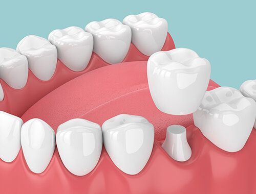 Dental Crowns
